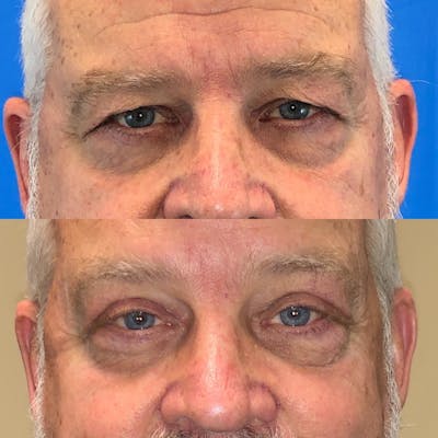 Upper Blepharoplasty Before & After Gallery - Patient 119935485 - Image 1