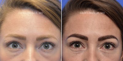 Lower Blepharoplasty Before & After Gallery - Patient 119935667 - Image 1