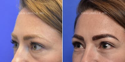 Lower Blepharoplasty Before & After Gallery - Patient 119935667 - Image 2
