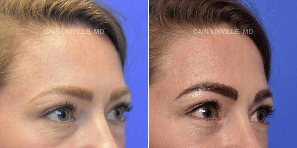 Lower Blepharoplasty Before & After Gallery - Patient 119935667 - Image 3