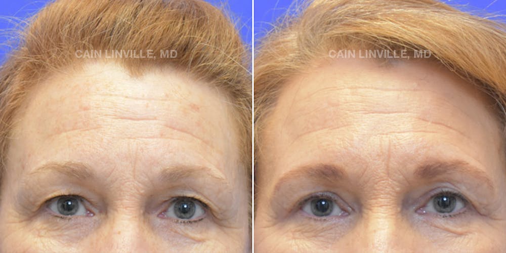 Lower Blepharoplasty Before & After Gallery - Patient 119935678 - Image 1