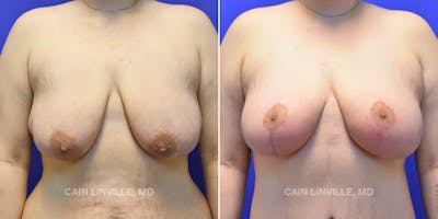 Breast Lift Before & After Gallery - Patient 119935748 - Image 1