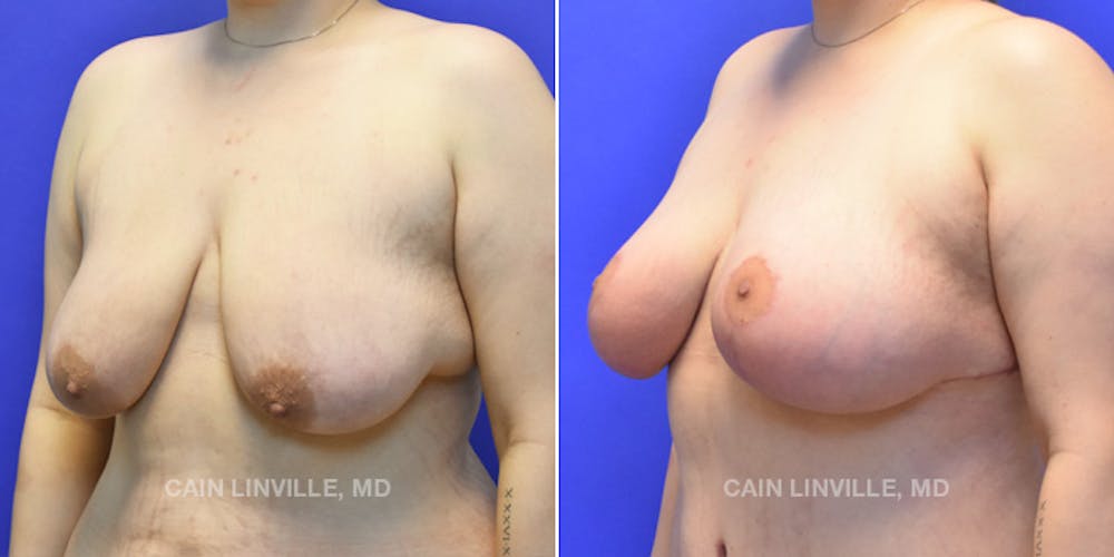 Breast Lift Before & After Gallery - Patient 119935748 - Image 2