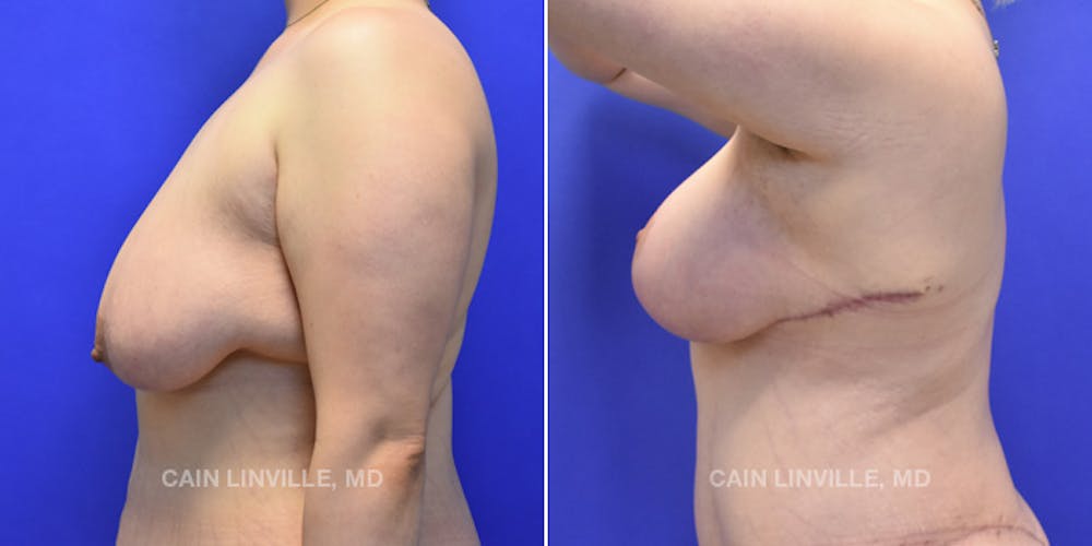 Breast Lift Before & After Gallery - Patient 119935748 - Image 3