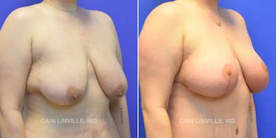Breast Lift Before & After Gallery - Patient 119935748 - Image 4
