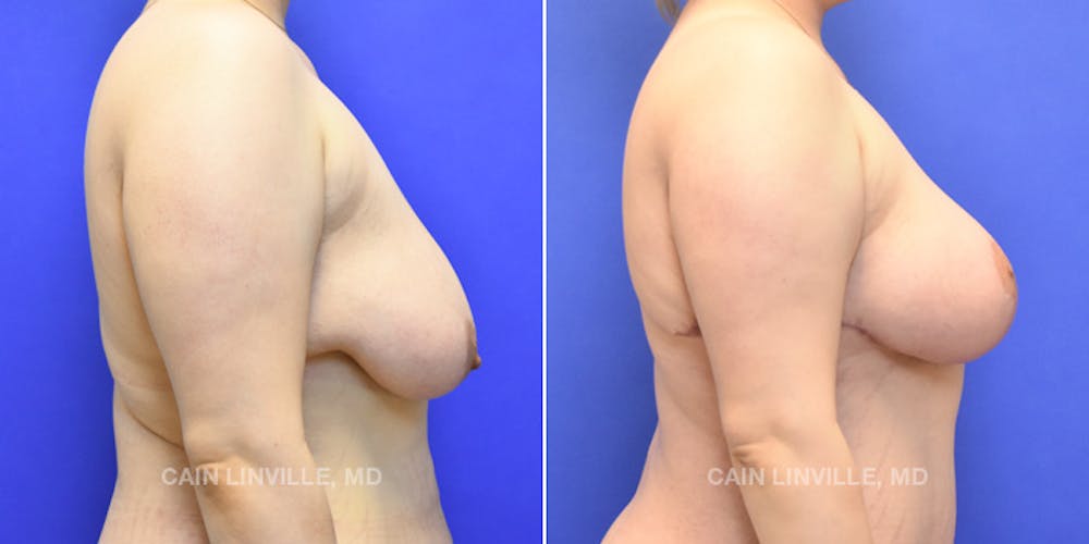 Breast Lift Before & After Gallery - Patient 119935748 - Image 5