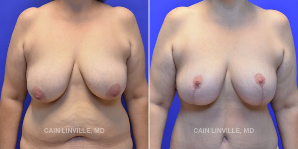 Breast Lift Before & After Gallery - Patient 119935749 - Image 1