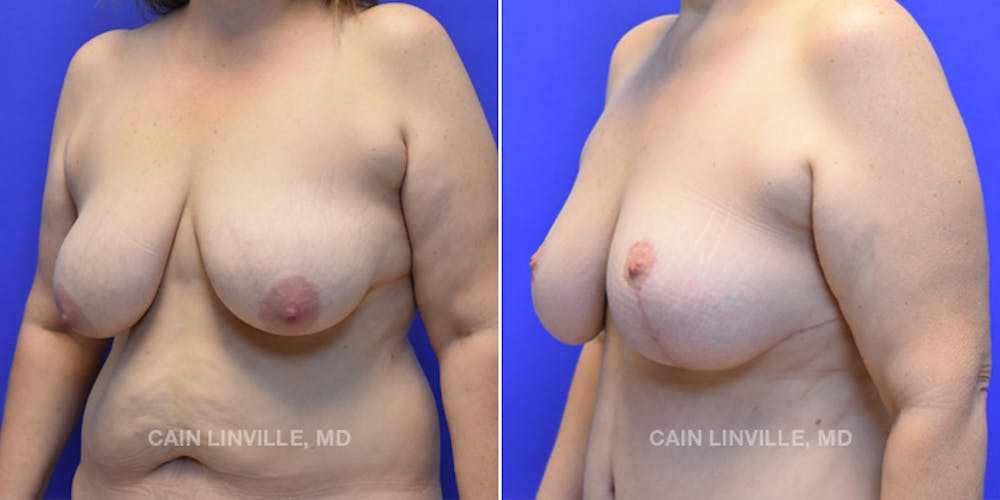Breast Lift Before & After Gallery - Patient 119935749 - Image 2