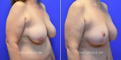 Breast Lift Before & After Gallery - Patient 119935749 - Image 4