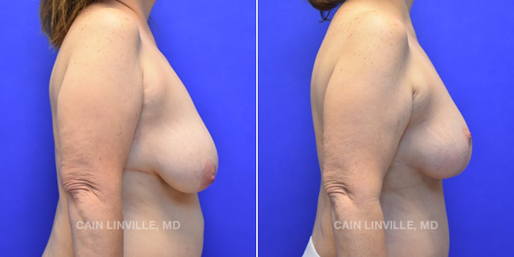 Breast Lift Before & After Gallery - Patient 119935749 - Image 5
