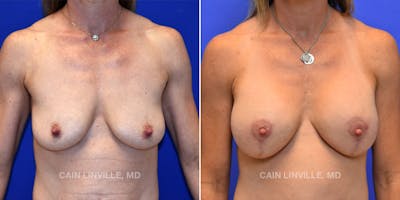 Breast Lift Before & After Gallery - Patient 119935750 - Image 1