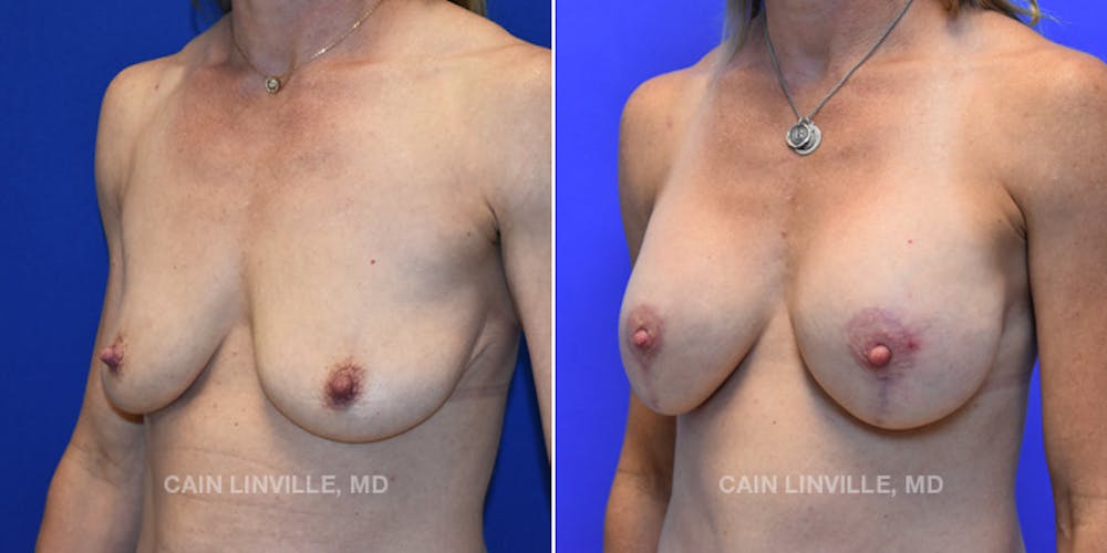 Breast Lift Before & After Gallery - Patient 119935750 - Image 2