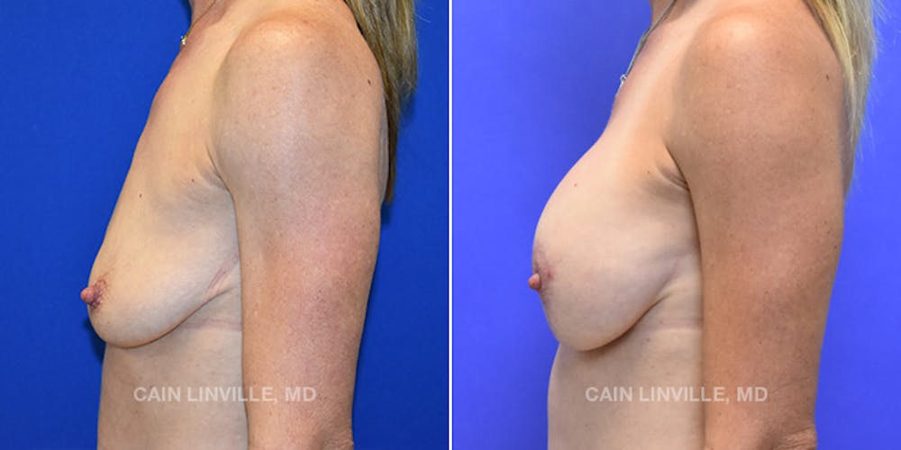 Breast Lift Before & After Gallery - Patient 119935750 - Image 3