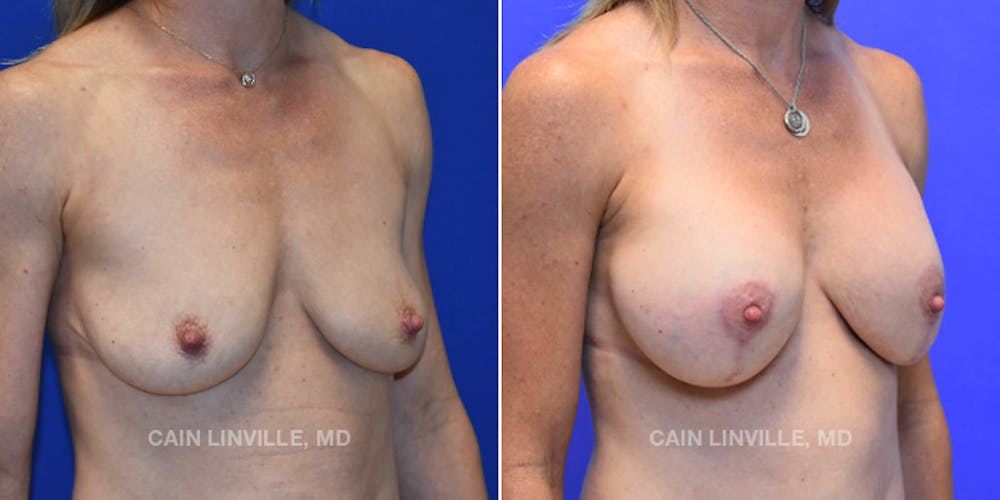 Breast Lift Before & After Gallery - Patient 119935750 - Image 4