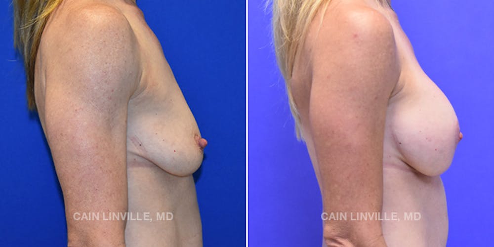 Breast Lift Before & After Gallery - Patient 119935750 - Image 5