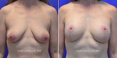 Breast Lift Before & After Gallery - Patient 119935751 - Image 1