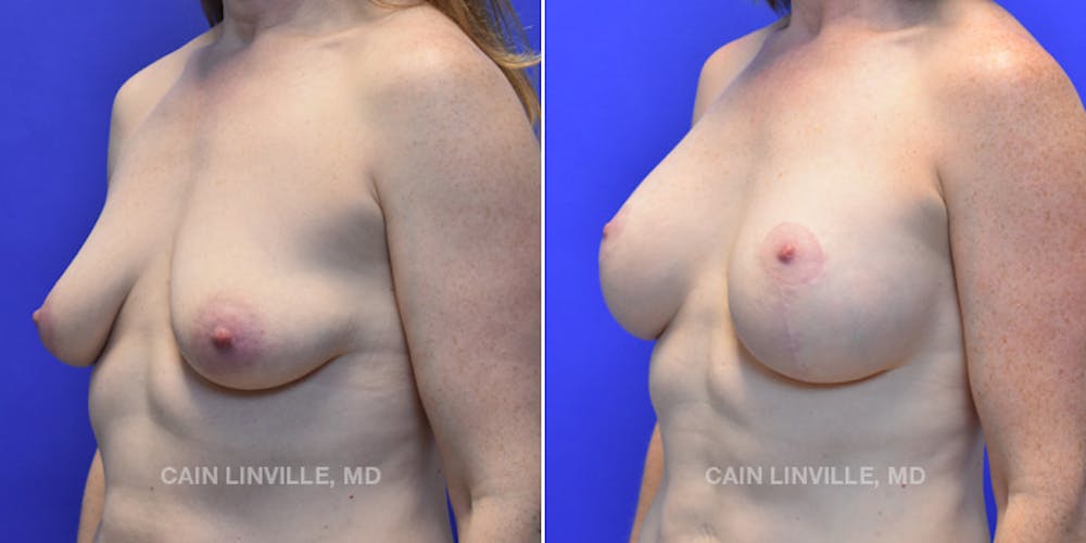 Breast Lift Before & After Gallery - Patient 119935751 - Image 2