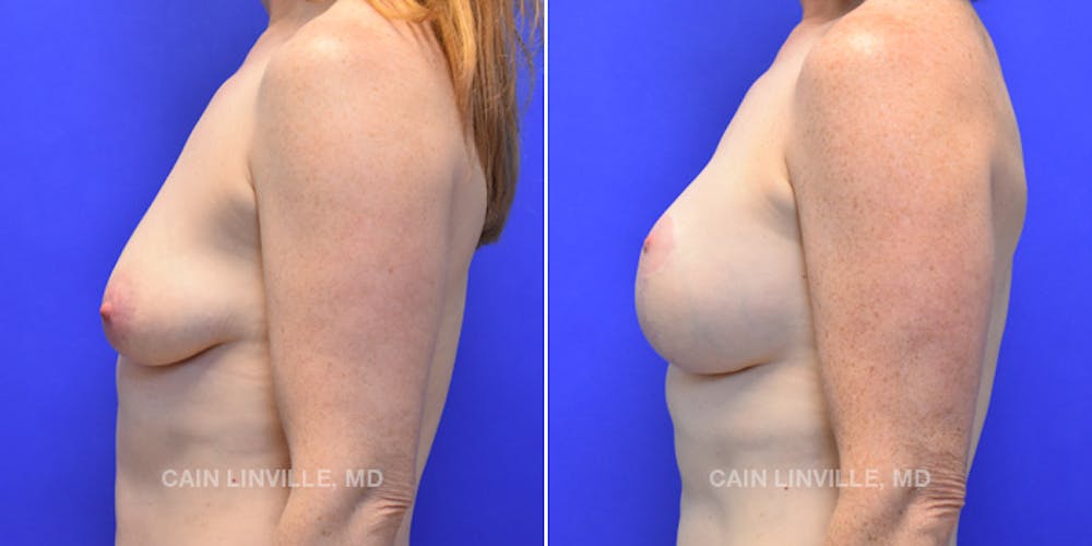 Breast Lift Before & After Gallery - Patient 119935751 - Image 3