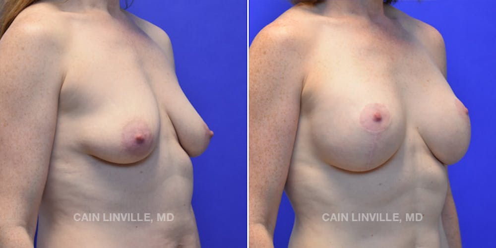 Breast Lift Before & After Gallery - Patient 119935751 - Image 4