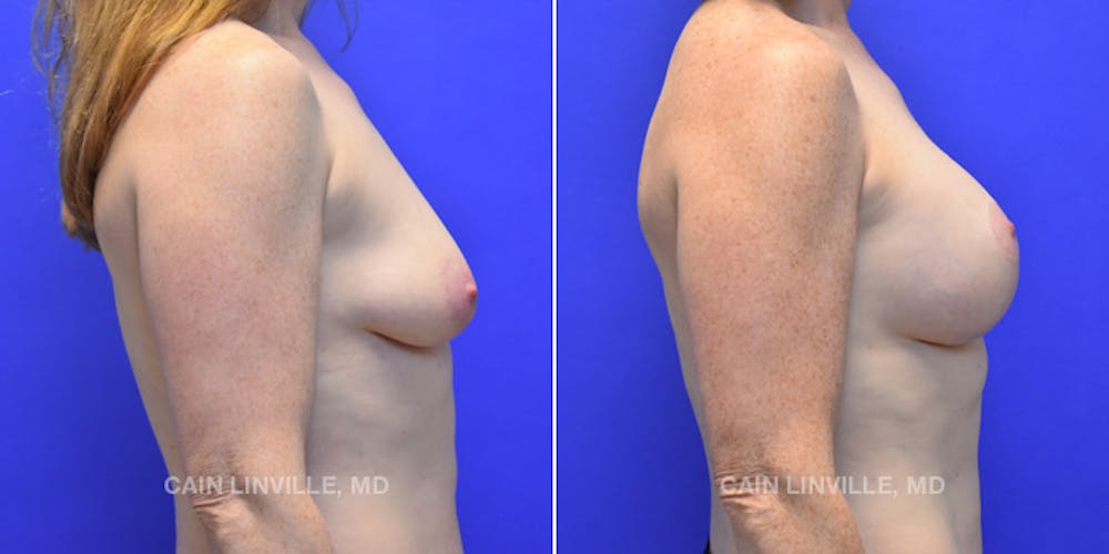 Breast Lift Before & After Gallery - Patient 119935751 - Image 5