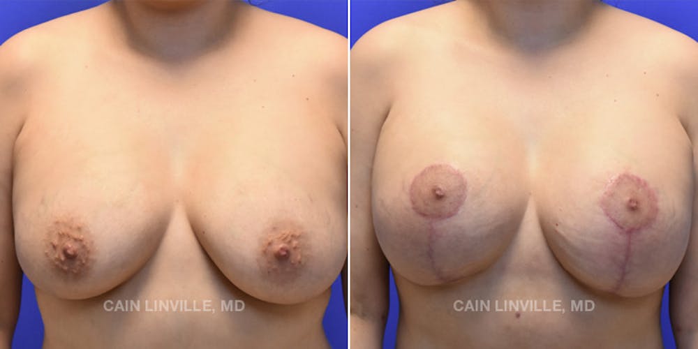 Breast Lift Before & After Gallery - Patient 119939977 - Image 1