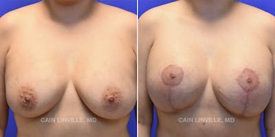 Breast Lift Before & After Gallery - Patient 119939977 - Image 1