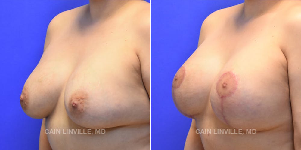 Breast Lift Before & After Gallery - Patient 119939977 - Image 2
