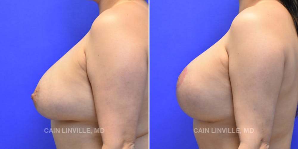 Breast Lift Before & After Gallery - Patient 119939977 - Image 3