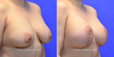 Breast Lift Before & After Gallery - Patient 119939977 - Image 4