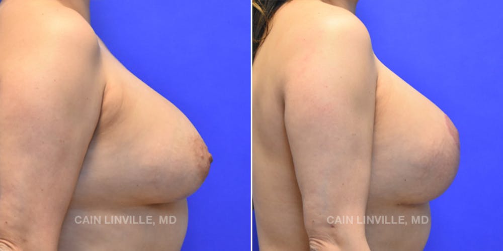 Breast Lift Before & After Gallery - Patient 119939977 - Image 5