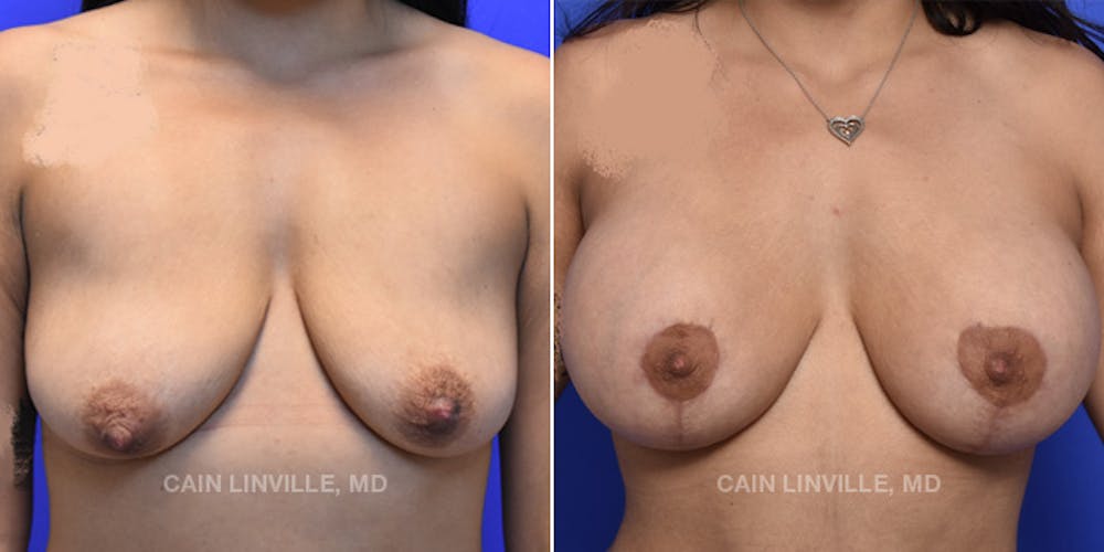 Breast Lift Before & After Gallery - Patient 119939978 - Image 1