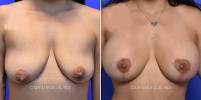 Breast Lift Gallery - Patient 119939978 - Image 1