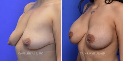Breast Lift Before & After Gallery - Patient 119939978 - Image 2