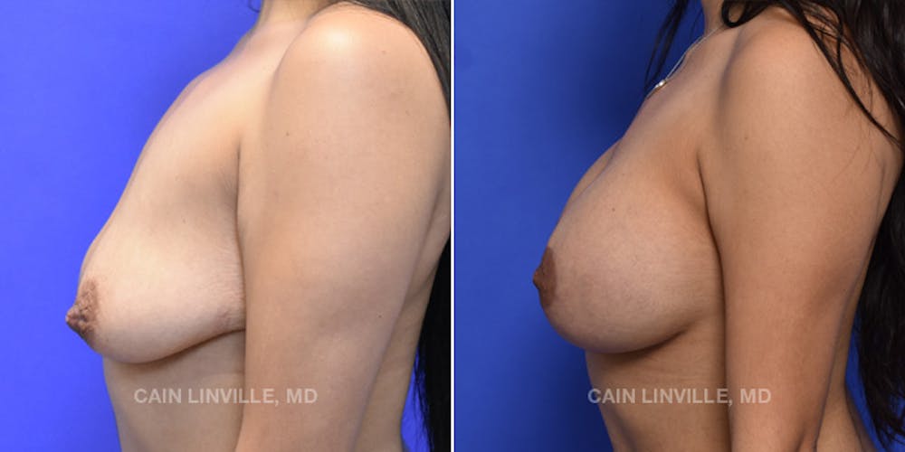 Breast Lift Before & After Gallery - Patient 119939978 - Image 3