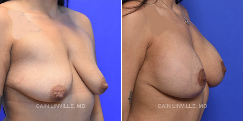 Breast Lift Before & After Gallery - Patient 119939978 - Image 4