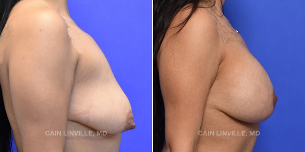 Breast Lift Before & After Gallery - Patient 119939978 - Image 5