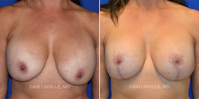 Breast Lift Before & After Gallery - Patient 119939979 - Image 1