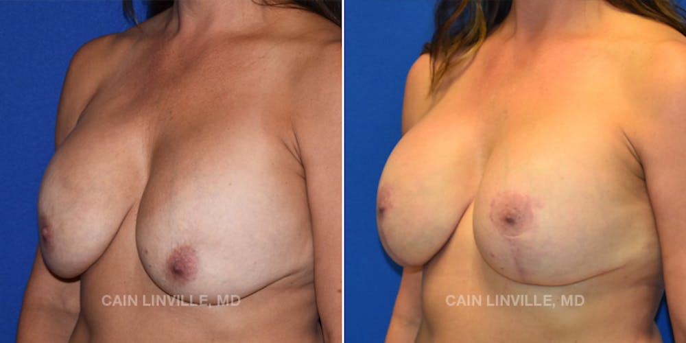 Breast Lift Before & After Gallery - Patient 119939979 - Image 2