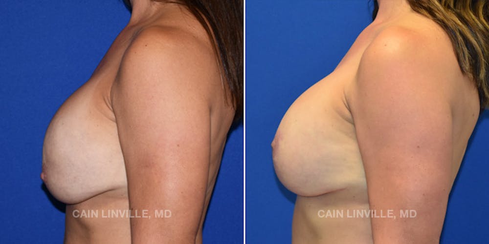 Breast Lift Before & After Gallery - Patient 119939979 - Image 3