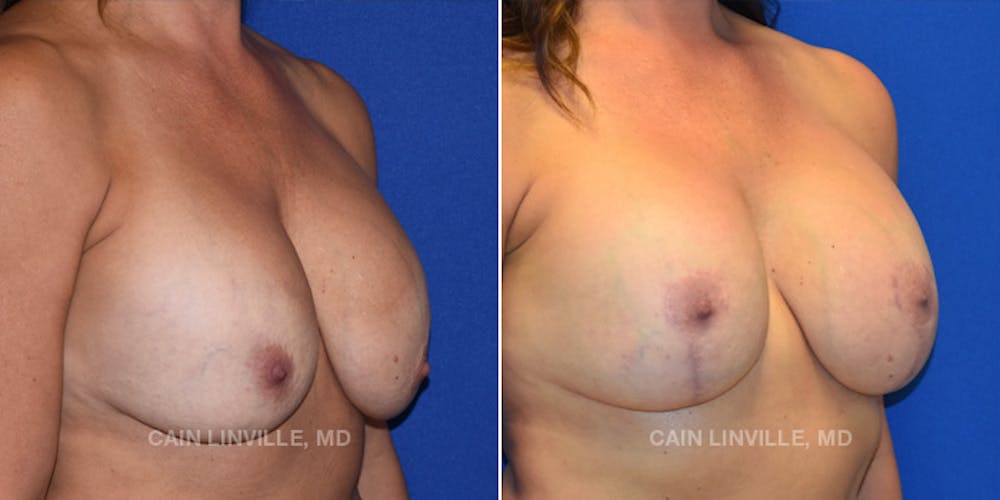 Breast Lift Before & After Gallery - Patient 119939979 - Image 4