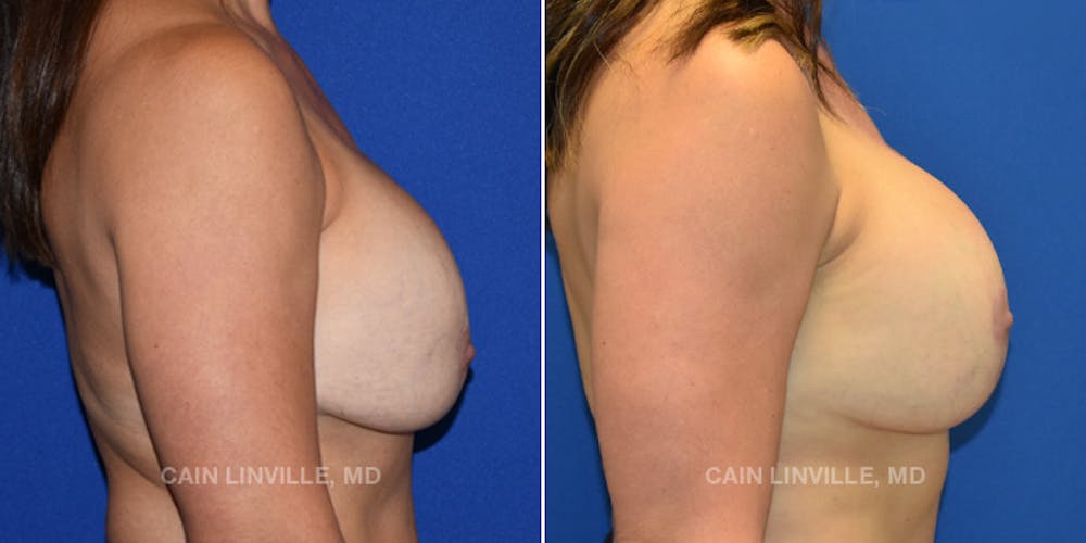 Breast Lift Before & After Gallery - Patient 119939979 - Image 5