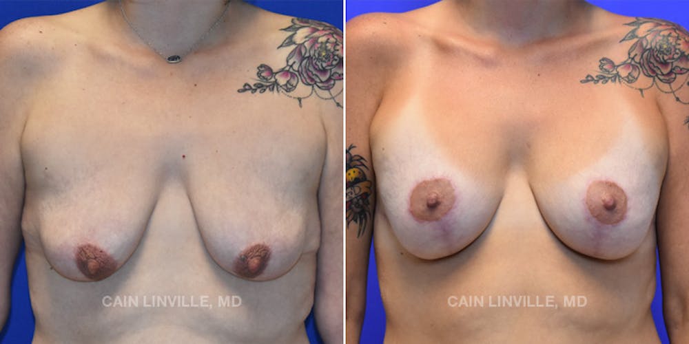 Breast Lift Before & After Gallery - Patient 119939980 - Image 1