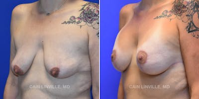 Breast Lift Before & After Gallery - Patient 119939980 - Image 2