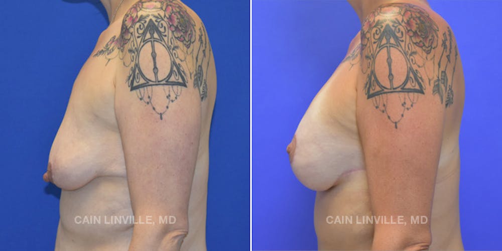 Breast Lift Before & After Gallery - Patient 119939980 - Image 3