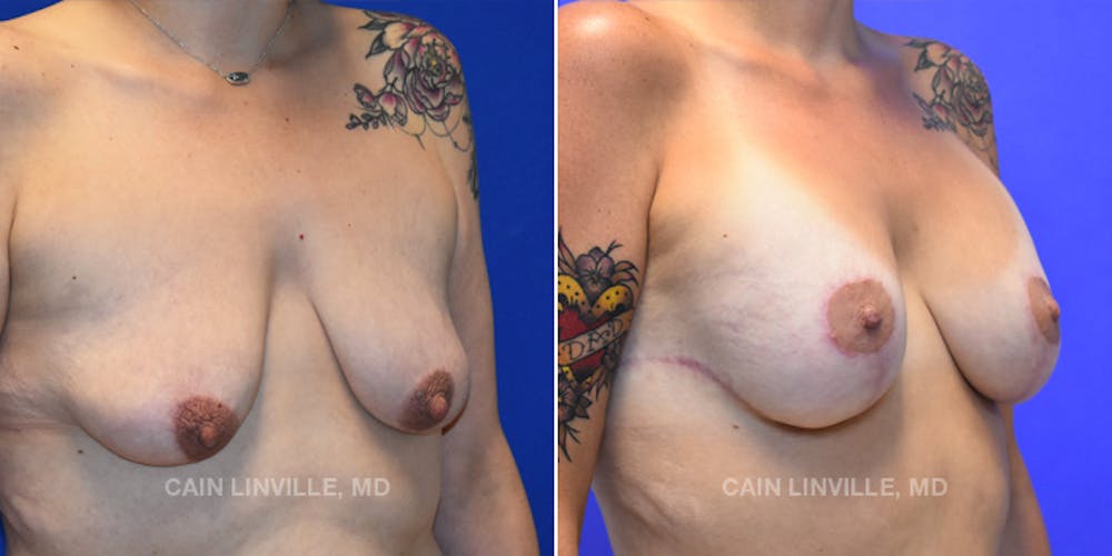 Breast Lift Before & After Gallery - Patient 119939980 - Image 4
