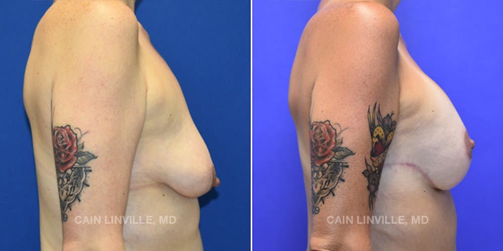 Breast Lift Before & After Gallery - Patient 119939980 - Image 5