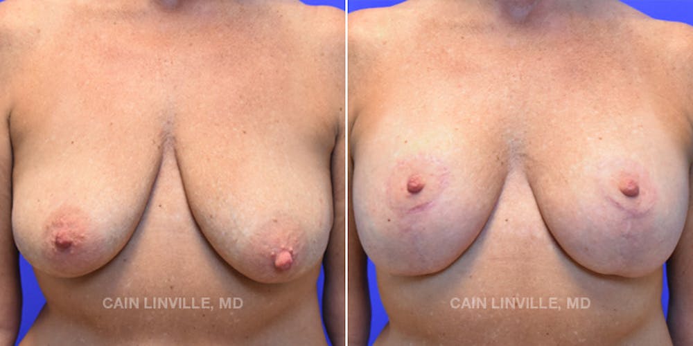 Breast Lift Before & After Gallery - Patient 119939981 - Image 1