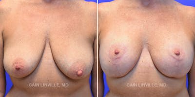 Breast Lift Gallery - Patient 119939981 - Image 1