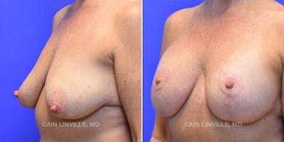 Breast Lift Before & After Gallery - Patient 119939981 - Image 2