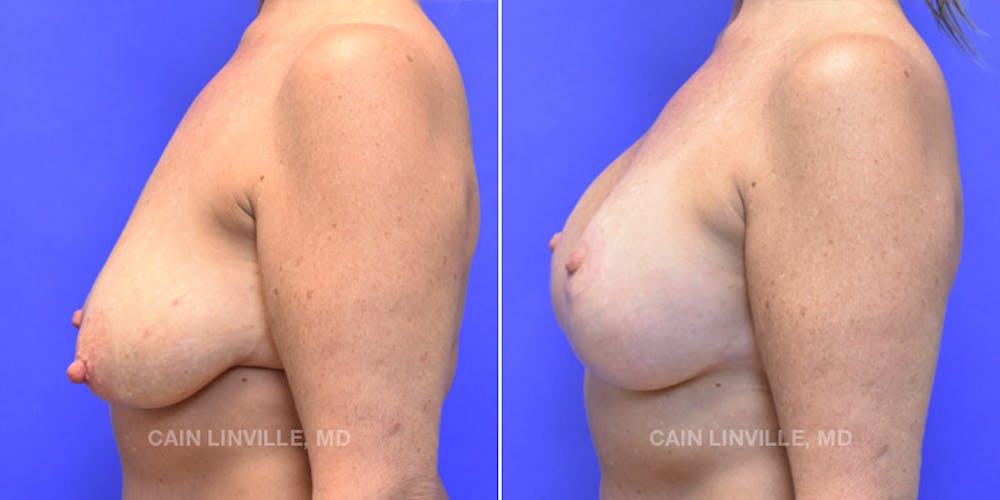 Breast Lift Before & After Gallery - Patient 119939981 - Image 3